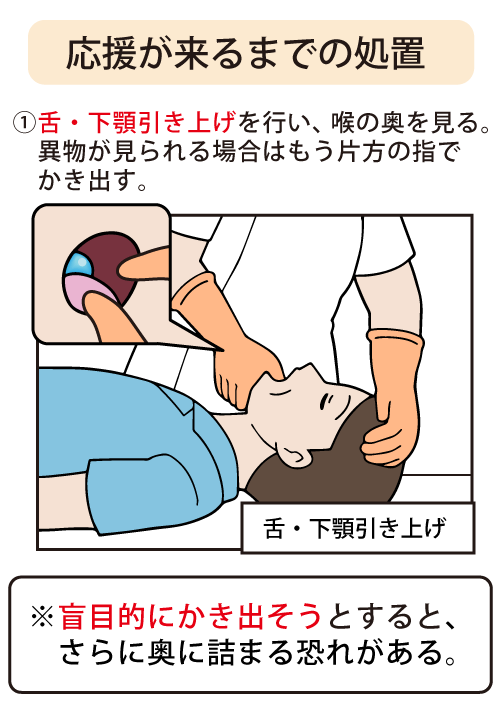 応援が来るまでの処置：舌・下顎引き上げを行い、喉の奥を見る。異物が見られる場合はもう片方の指でかき出す。※盲目的にかき出そうとすると、さらに奥に詰まる恐れがあります
