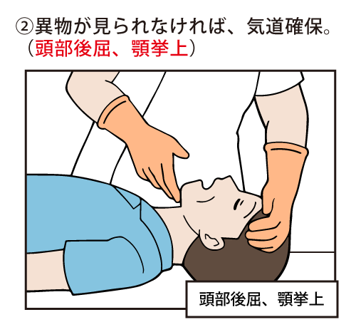 異物が見られなければ、気道確保。（頭部後屈、顎挙上）