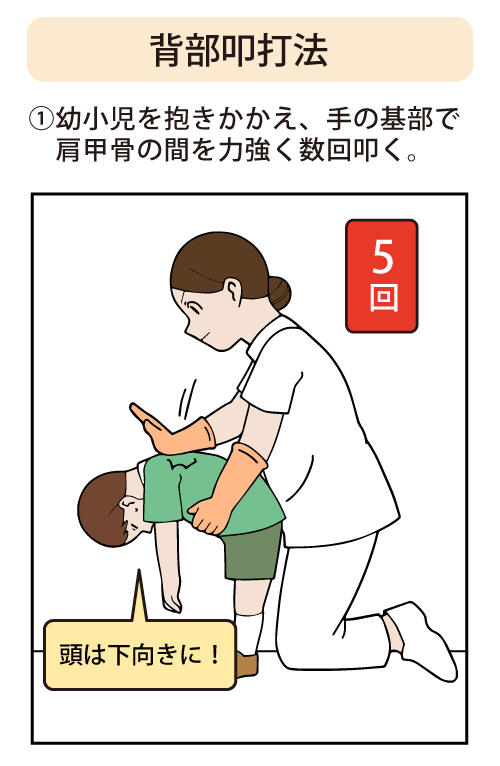 背部叩打法：①幼小児を抱きかかえ、手の基部で肩甲骨の間を力強く数回叩く。