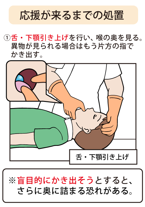 応援が来るまでの処置：舌・下顎引き上げを行い、喉の奥を見る。異物が見られる場合はもう片方の指でかき出す。※盲目的にかき出そうとすると、さらに奥に詰まる恐れがあります
